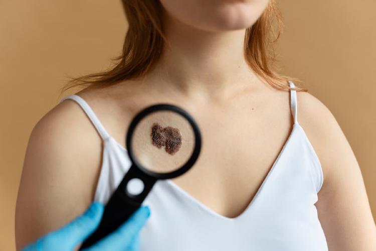 Waspada Kanker Kulit, Penyebab Dan Gejala Kanker Kulit